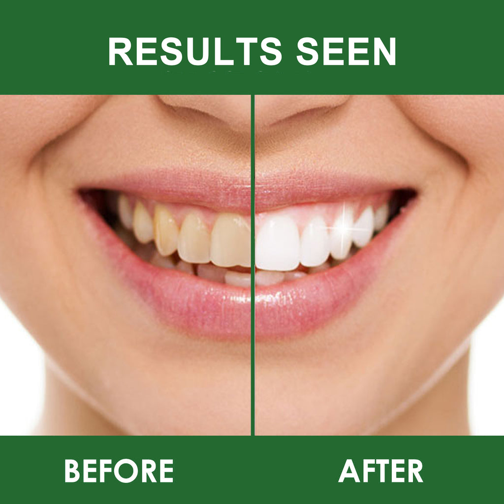 Teeth Whitening Strips - Gentle Teeth Oral Care | 14 Strips | Dropship